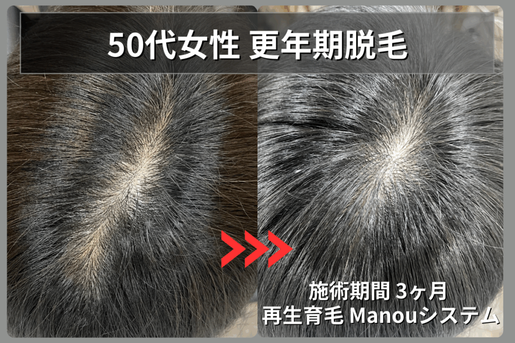50代女性の更年期薄毛（びまん性脱毛症）が再生育毛Manouシステムで3ヶ月後に分け目が改善したビフォーアフター