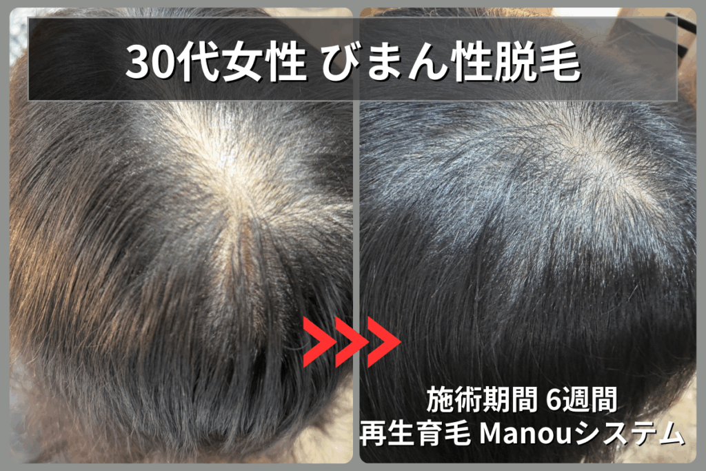 30代女性のびまん性脱毛症が再生育毛Manouシステムで6週間後に髪の密度が劇的に改善したビフォーアフター