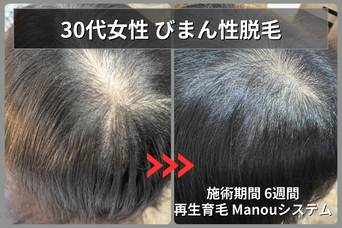 30代女性のびまん性脱毛症が再生育毛Manouシステムで6週間後に髪の密度が劇的に改善したビフォーアフター
