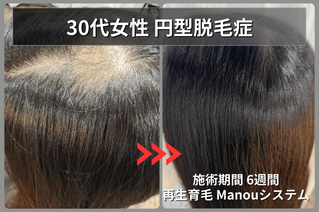 30代女性の直径10cm以上の重度円形脱毛症が再生育毛Manouシステムで2ヶ月後に改善したビフォーアフター