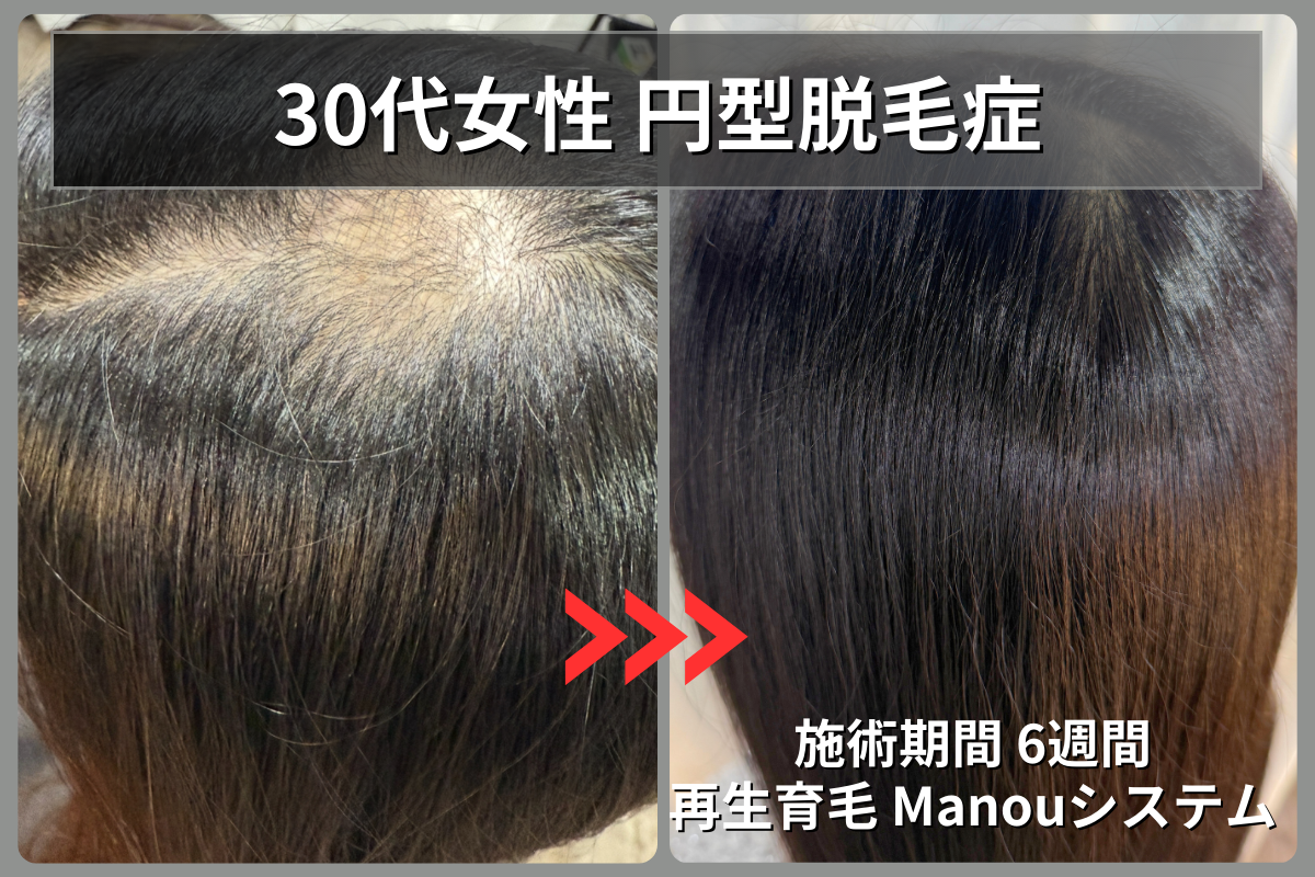 30代女性の直径10cm以上の重度円形脱毛症が再生育毛Manouシステムで2ヶ月後に改善したビフォーアフター