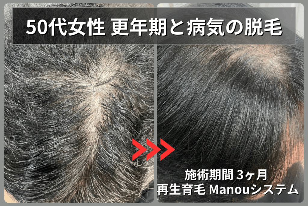 50代女性の急性脱毛が再生育毛Manouシステムで3ヶ月で改善しボリュームと黒髪が回復した事例