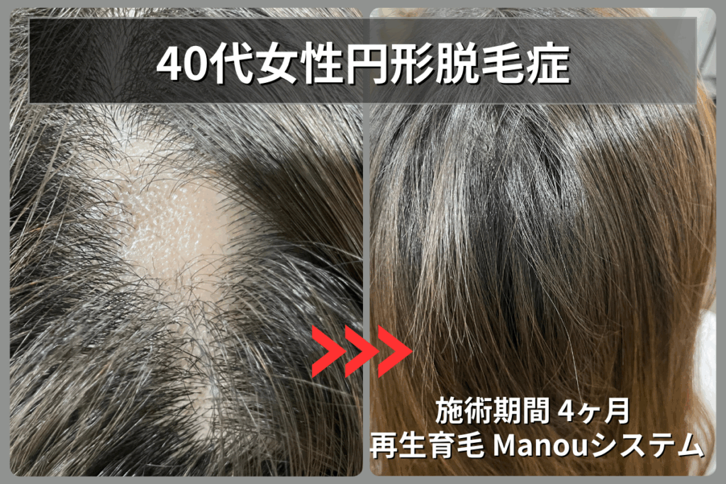 40代女性の円形脱毛症が再生育毛Manouシステムで4ヶ月後に完全に改善したビフォーアフター